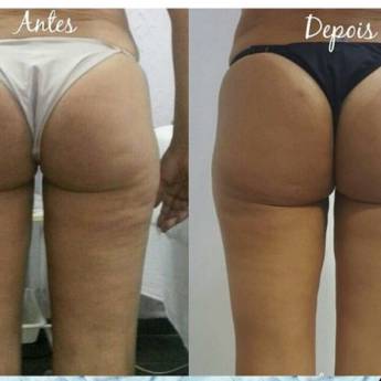 Comprar o produto de Criofrequência e Cavitação em Avaré em Clínicas de Estética e Beleza em Avaré, SP por Solutudo