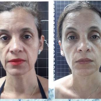 Comprar o produto de Criofrequência - Rosto em Avaré em Clínicas de Estética e Beleza em Avaré, SP por Solutudo