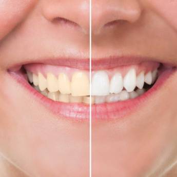 Comprar produto Odontologia estética (clareamento, facetas e lentes de contato) em Saúde pela empresa Dra Juliana Assis | Ortodontia em Aracaju, SE