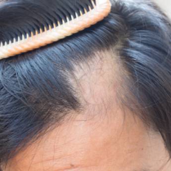 Comprar o produto de Alopécia  em Beleza, Estética e Bem Estar em Aracaju, SE por Solutudo