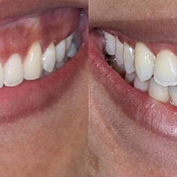 Comprar o produto de Gengivectoplastia em A Classificar em Bauru, SP por Solutudo