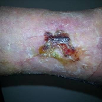 Comprar o produto de Tratamento de Úlcera Venosa em Saúde em São Paulo, SP por Solutudo