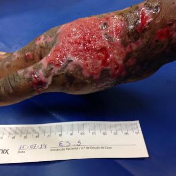 Comprar o produto de Tratamento de Queimaduras em Saúde em São Paulo, SP por Solutudo