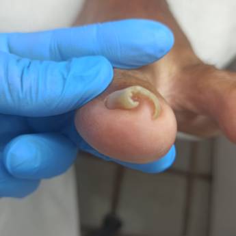 Comprar o produto de Correção ungueal em Podologia em Aracaju, SE por Solutudo