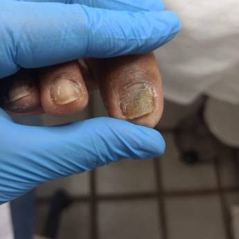 Comprar o produto de Onicomicose (fungos) em Podologia em Aracaju, SE por Solutudo