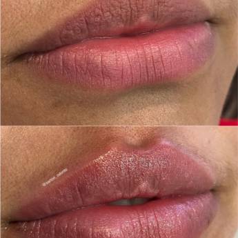Comprar o produto de Preenchimento Labial em Odontologia em Assis, SP por Solutudo