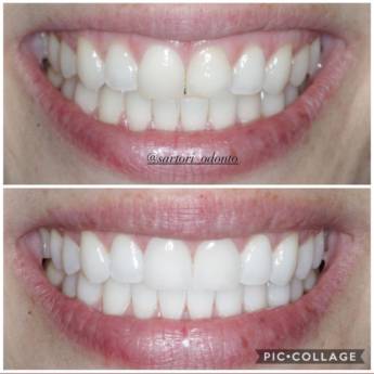 Comprar o produto de Gengivoplastia em Odontologia em Assis, SP por Solutudo