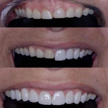 Comprar o produto de Laminados em Odontologia em Assis, SP por Solutudo