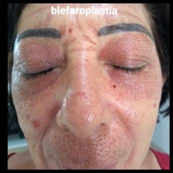 Comprar o produto de Blefaroplastia em Estética Facial em Jaboticabal, SP por Solutudo