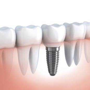 Comprar o produto de Implante Dentario em Implantes em Itatiba, SP por Solutudo