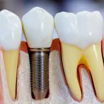 Comprar o produto de Ortodontia e Implante em Ortodontia em Assis, SP por Solutudo