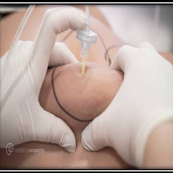 Comprar o produto de Carboxterapia em Estética Corporal em Piracicaba, SP por Solutudo