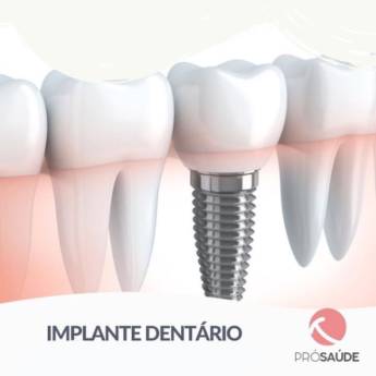 Comprar o produto de Implante dentário em Odontologia em São Manuel, SP por Solutudo
