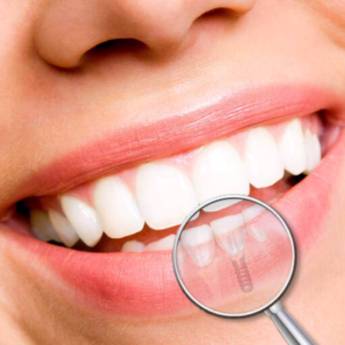 Comprar o produto de Implante Dentário em Tratamento Dentário em Aracaju, SE por Solutudo