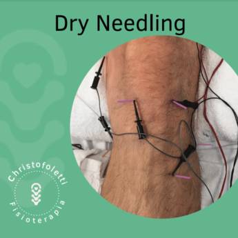 Comprar o produto de Dry Needling em Clínicas de Estética e Beleza em Piracicaba, SP por Solutudo