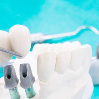 Comprar o produto de Implante Dentário em Estética Odontológica em Jundiaí, SP por Solutudo