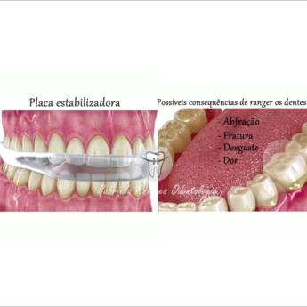 Comprar o produto de Tratamento de Bruxismo - Dra. Gabriela Antunes Silva  em Odontologia em Botucatu, SP por Solutudo