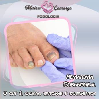 Comprar o produto de Hematoma nas unhas em Podologia em Botucatu, SP por Solutudo