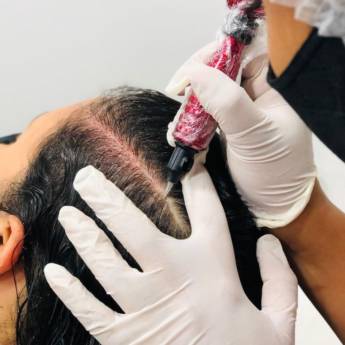 Comprar o produto de Tratamento Capilar - Microagulhamento  em Beleza e Cuidado Pessoal em Jundiaí, SP por Solutudo