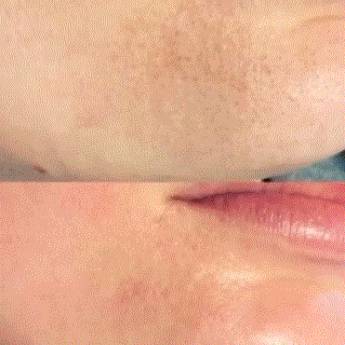 Comprar o produto de Peeling químico em Beleza, Estética e Bem Estar em São José, SC por Solutudo