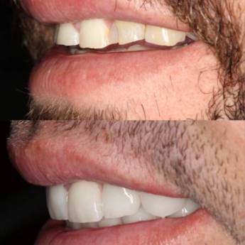 Comprar o produto de Tratamento de facetas em Odontologia em Cândido Mota, SP por Solutudo