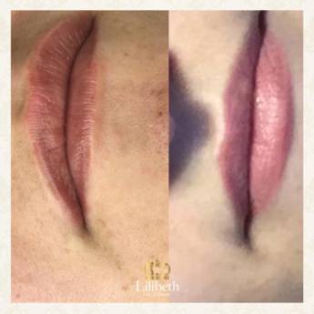 Comprar o produto de Revitalização labial em Revitalização labial em Jundiaí, SP por Solutudo