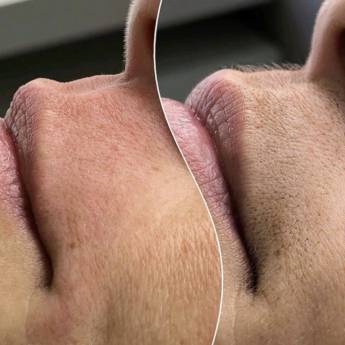 Comprar o produto de Depilação de buço em Depilação em Garça, SP por Solutudo