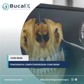 Comprar produto Cone Bean - Tomografia Computadorizada  em Radiologia Odontológica pela empresa Bucalx Radiologia Odontológica em Botucatu, SP