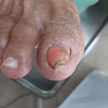 Comprar o produto de Tratamento de micose nos pés em Pedicure em Assis, SP por Solutudo