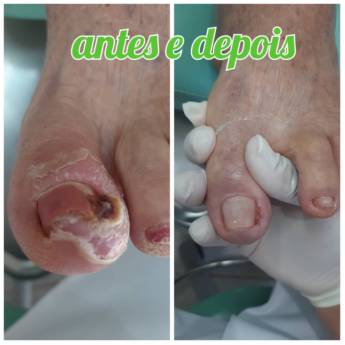 Comprar o produto de Cuidar de encravamentos em Pedicure em Assis, SP por Solutudo