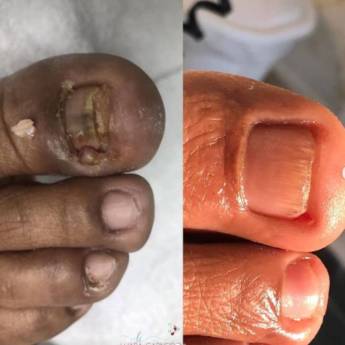 Comprar o produto de Tratamento de Onicomicose em Podologia em Indaiatuba, SP por Solutudo