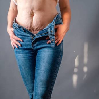 Comprar o produto de Tratamento para flacidez da pele em Bauru  em Estética Corporal em Bauru, SP por Solutudo