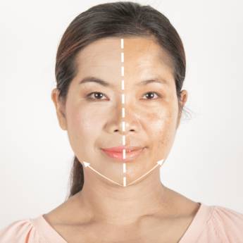 Comprar o produto de Tratamento de manchas/ melasma em Bauru em Estética Facial em Bauru, SP por Solutudo