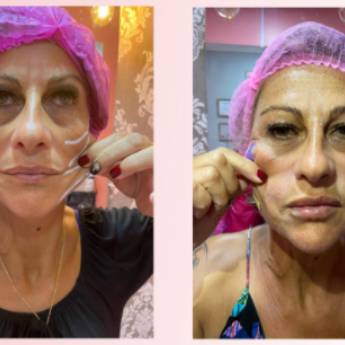 Comprar o produto de Fios de PDO - Sustentação em Estética Facial pela empresa Beauty Forever - Estética Fácil e Corporal em Foz do Iguaçu, PR por Solutudo