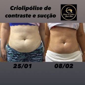 Comprar o produto de Estética Corporal em Estética Corporal em Presidente Dutra, MA por Solutudo