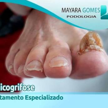 Comprar o produto de Tratamento Onicogrifose  em Podologia em Botucatu, SP por Solutudo