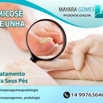 Comprar o produto de Micose de Unha  em Podologia em Botucatu, SP por Solutudo