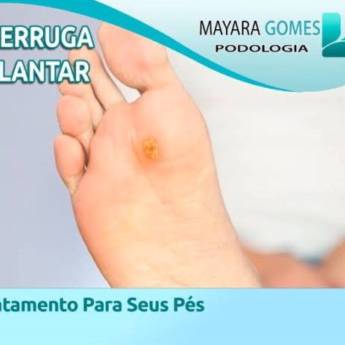 Comprar o produto de Verruga Plantar (Olho de peixe)  em Podologia em Botucatu, SP por Solutudo