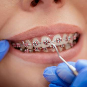 Comprar o produto de Dentista para colocação de aparelho dentário em Bauru em Aparelhos em Bauru, SP por Solutudo