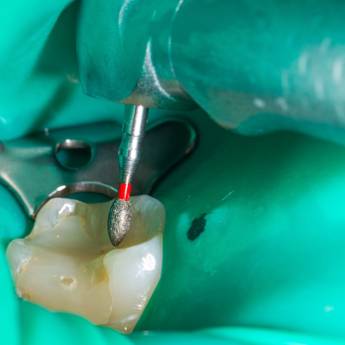 Comprar o produto de Restaurações em Odontologia em Bofete, SP por Solutudo