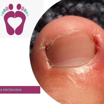 Comprar o produto de UNHA ENCRAVADA  em Podologia em Botucatu, SP por Solutudo