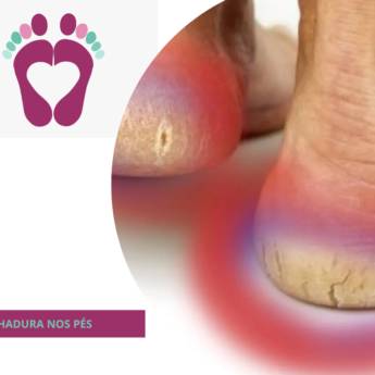 Comprar o produto de RACHADURA NOS PÉS  em Podologia em Botucatu, SP por Solutudo