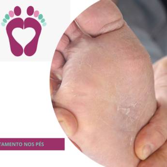 Comprar o produto de TRATAMENTO NOS PÉS  em Podologia em Botucatu, SP por Solutudo