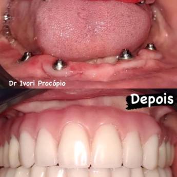 Comprar o produto de Implantes Dentários em São Paulo – Odonto Los Angeles em Odontologia em São Paulo, SP por Solutudo