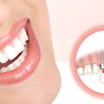 Comprar o produto de Implantodontia em Odontologia em Aracaju, SE por Solutudo