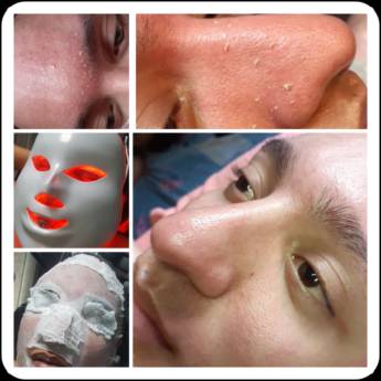 Comprar o produto de Limpeza de pele em Estética Facial em Frutal, MG por Solutudo