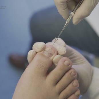 Comprar o produto de Tratamento de Unhas Encravadas em Tratamentos Alternativos em Itaí, SP por Solutudo