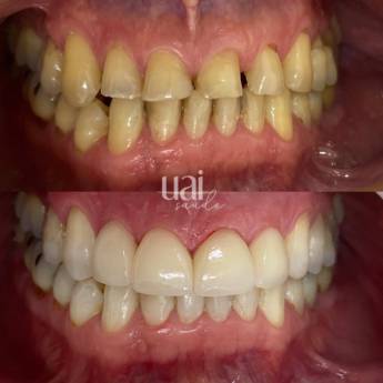 Comprar produto Estética dentária em Odontologia pela empresa Uai Saude em Jundiaí, SP