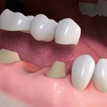 Comprar o produto de Ponte Fixa em Odontologia em Osasco, SP por Solutudo