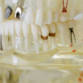 Comprar o produto de Provisório Sobre Implante em Odontologia em Osasco, SP por Solutudo